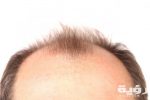 top of head with receding hairline scaled