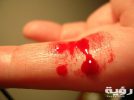 تفسير رؤية شخص ينزف دم في المنام 4 Bleeding finger scaled
