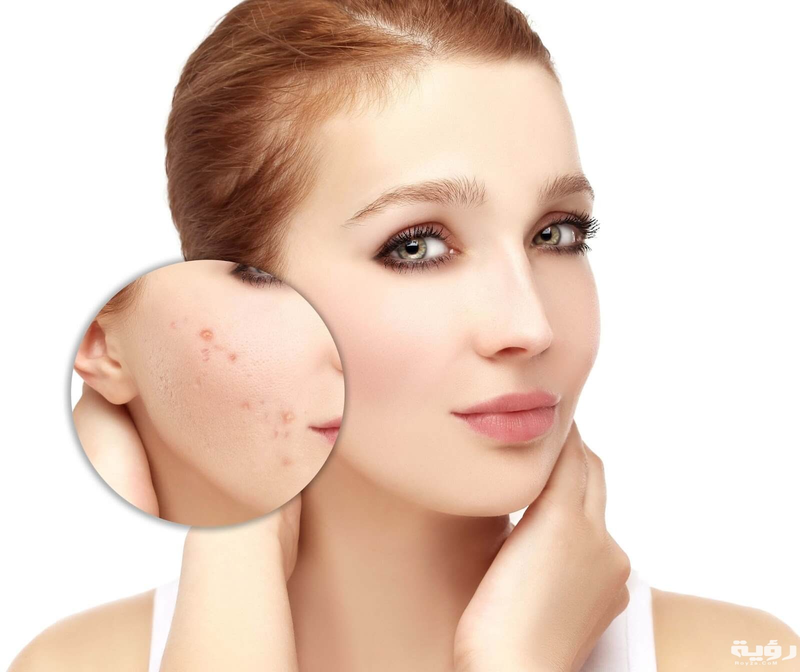 تفسير رؤية حب الشباب في المنام 2 حبوب الوجه