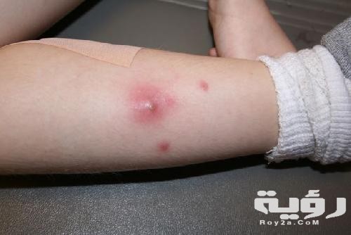 تفسير رؤية الدمامل في المنام 3 الدمامل في المنام