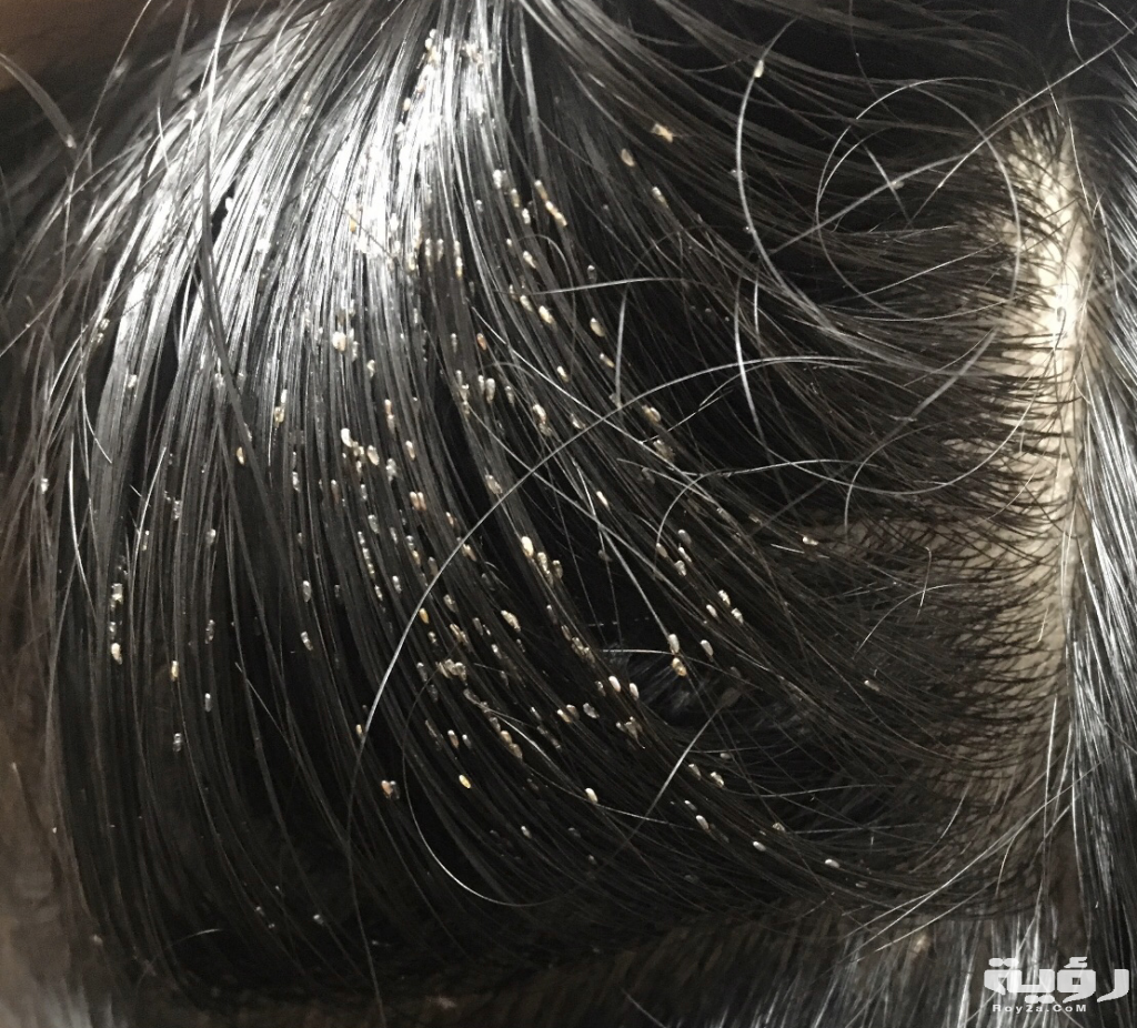 حلمت أني أخرج قمل من شعر أختي 5
