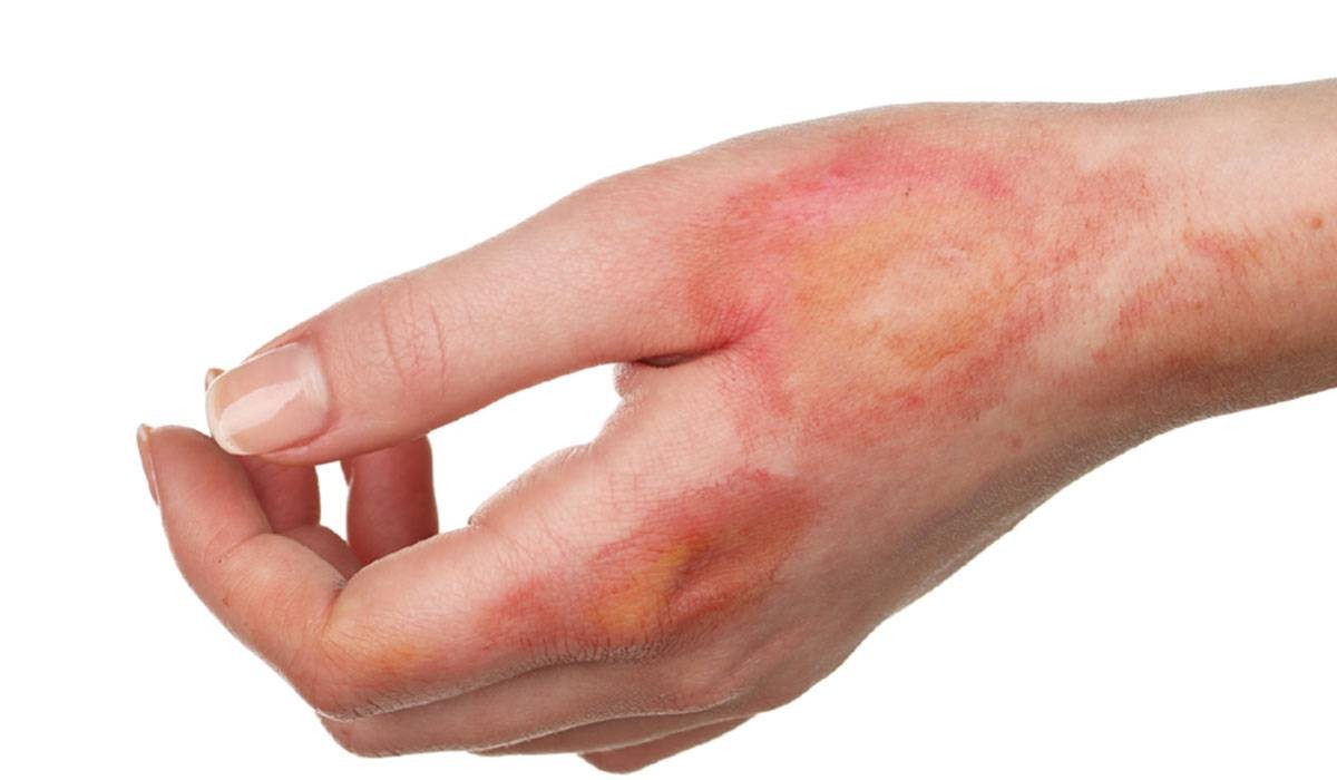 حلمت ان يدي محروقه 1 الحروق