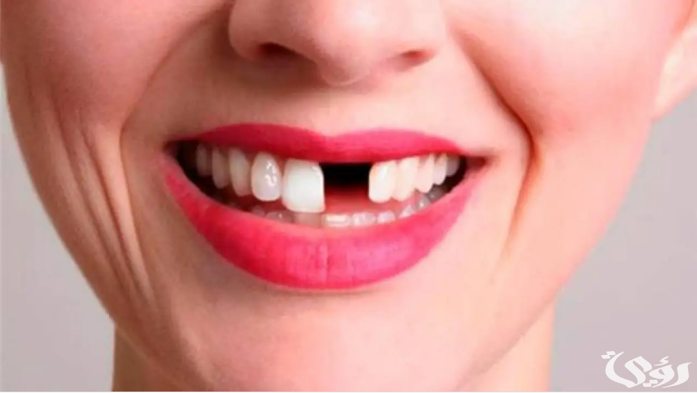 تفسير حلم سقوط الأسنان مع الدم