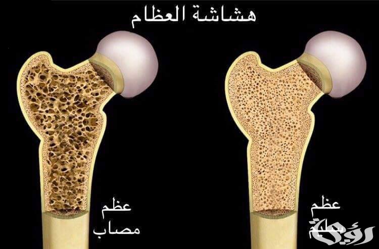 اذاعة مدرسية عن هشاشة العظام