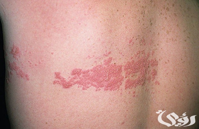 أفضل 5 أنواع مسكن للحزام الناري