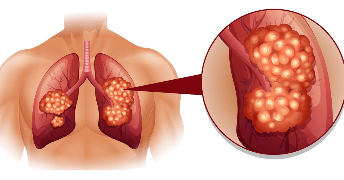 اذاعة مدرسية عن سرطان الرئة