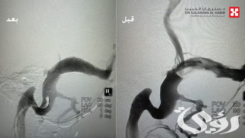 نجاح زراعة دعامة دماغية في مستشفى الدكتور سليمان الحبيب بالخبر 5 مستشفى الدكتور سليمان الحبيب بالخبر ينجح بزراعة دعامة دماغية لإنهاء معاناة استمرت 4 سنوات لخمسينية من طنين الأذن النابض