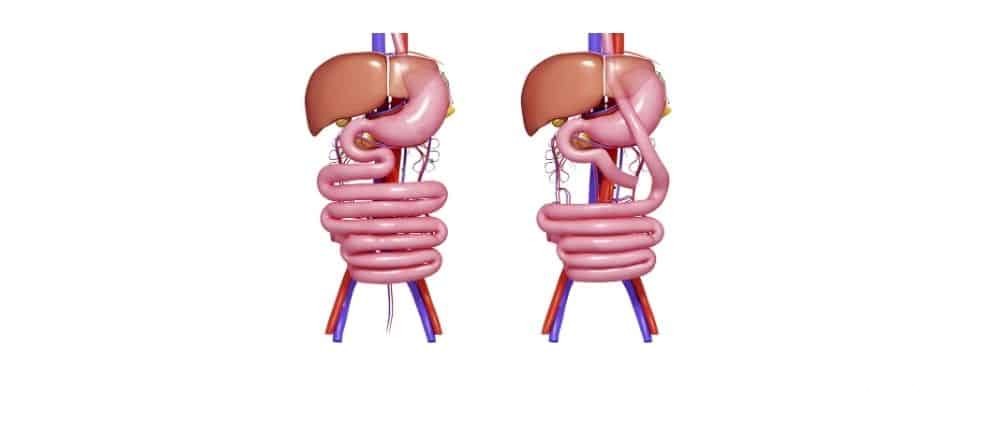 تكلفة عملية تحويل مسار المعدة في الكويت 2026 3 تكلفة عملية تحويل مسار المعدة في الكويت