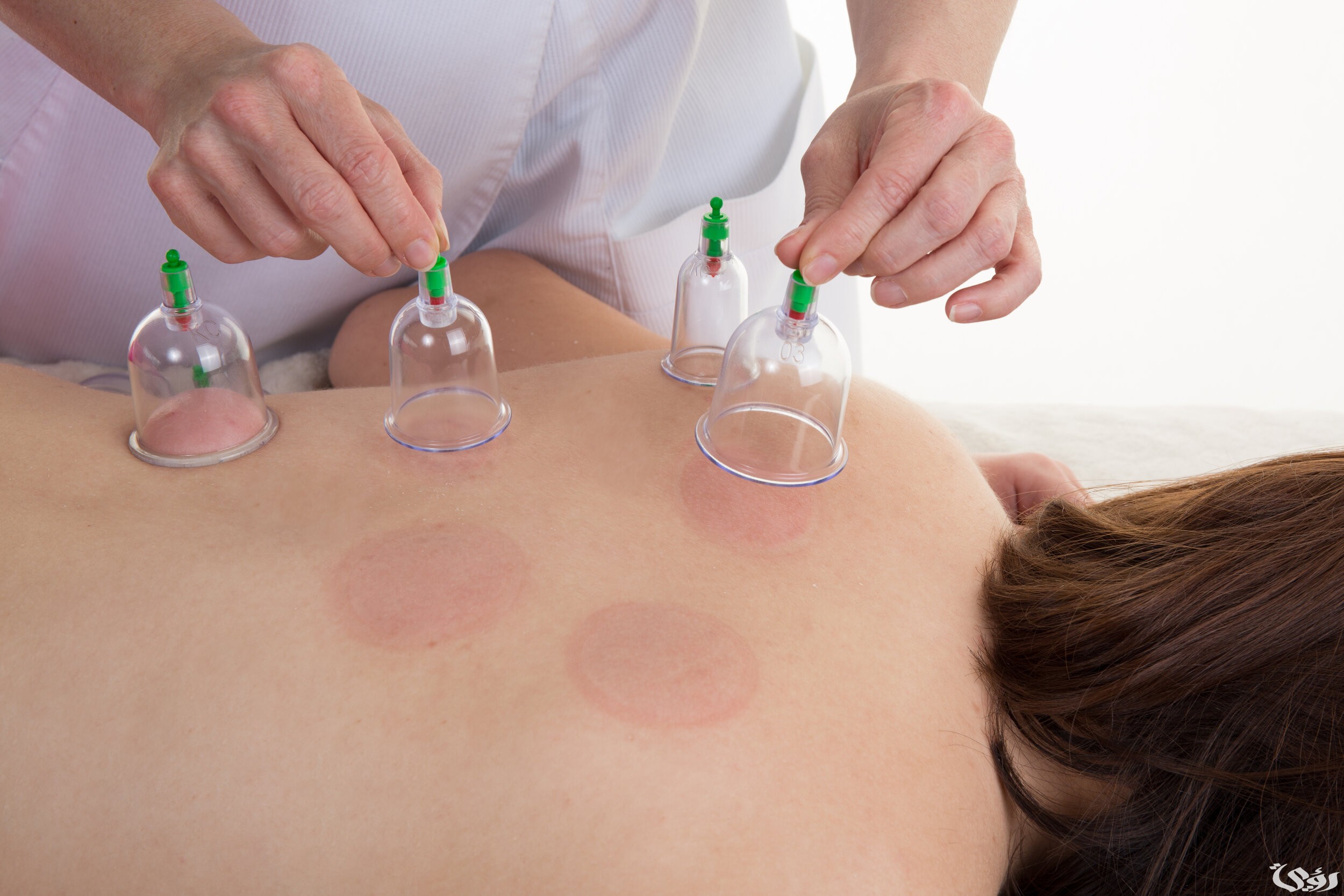 أسعار الحجامة في أفضل مراكز الكويت 2026 3 سعر الحجامة في أفضل مراكز الكويت