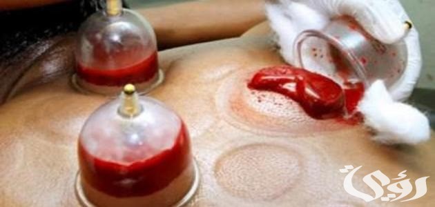 مستشار تأهيل طبي: الحجامة تحسّن الدورة الدموية للمريض وتنشط الخلايا